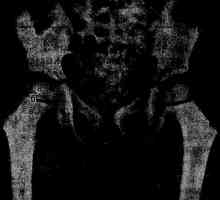 Osteolýza kostní eroze