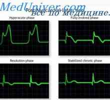 Akutní fáze infarktu přední stěny. Infarkt myokardu zadní stěny na EKG