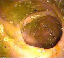 Pinworms ve střevě, konečníku, řitního otvoru střevní enterobiosis