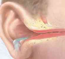 Akutní hnisavý zánět středního ucha: léčba, příznaky, znaky, příčiny