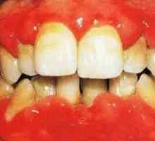 Akutní nekrotizující ulcerózní zánět dásní