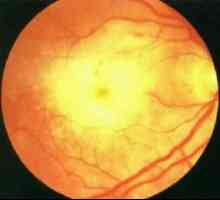 Akutní retinální nekróza: příznaky, léčba, příčiny, příznaky