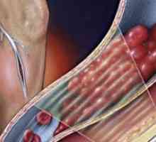 Akutní trombóza hlubokých žil dolních končetin: léčba, symptomy