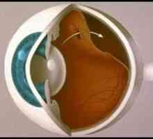 Odloučení sítnice očí: příčiny, příznaky, léčba, symptomy