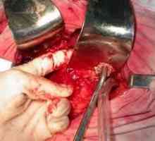Pancreatonecrosis provoz období po operaci