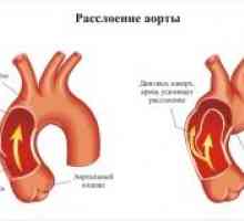 Aortální patologie v těhotenství