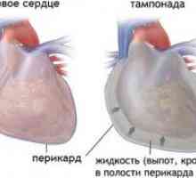 Perikardiální výpotek a srdeční tamponáda