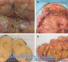 Primární hyperaldosteronismus (Conn onemocnění) morfologie, patologické anatomie