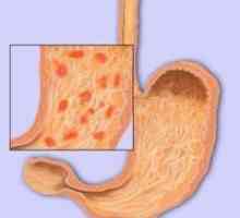 První známky a příznaky gastritida žaludku