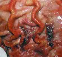 Rakovina dlaždicových buněk žaludku