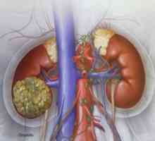 Renální karcinom: léčba, příznaky, příčiny, příznaky