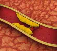 Slinivka břišní a cholesterol