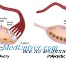 Polycystických vaječníků. matný syndrom - Leventhal