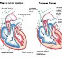 Srdeční vada Fallotova tetralogie: léčba, prognóza, příznaky, symptomy, příčiny