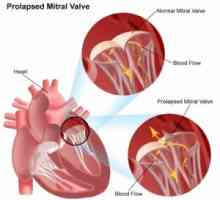 Mitrální srdeční chlopně: léčba, symptomy