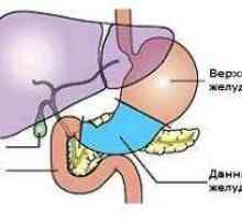Následky a léčba rakoviny žaludku po operaci