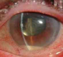 Pooperační Endoftalmitida oči