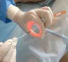 Laser poleptání žaludeční vřed jako způsobu léčení