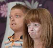 Progeria děti: příznaky, léčba, příčiny
