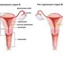Rakovina endometria: symptomy, stupeň, léčení, diagnózu, prognózu, příčiny, příznaky, prevence