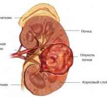 Karcinomu ledvinové pánvičky a močovodu: příznaky, symptomy, příčiny, léčba