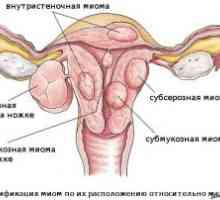 Rakovina dělohy: stupeň, příznaky, léčba, diagnóza