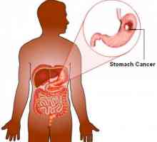 Rakovina žaludku: patogeneze, histologie, jak dlouho