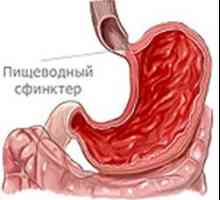 Refluxní esofagitida stupeň 3