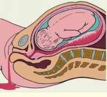 Krvácení z konečníku v průběhu těhotenství