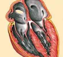 Restriktivní kardiomyopatie