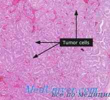 Clasmocytoma a lymfom štítné žlázy. Fluorescenční mikroskopie štítné žlázy