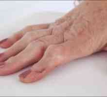 Revmatoidní artritida prstů: příznaky, léčba, příčiny, příznaky