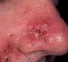 Růžová nebo červená akné: léčba, příznaky, znaky, příčiny