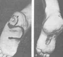 Scar deformity nohy a kotníku. vady léčba klenutou plochu chodidla s ohledem na povrchové vřed