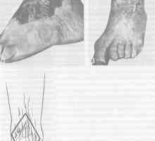 Scar deformity nohy a kotníku