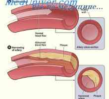 Familiární hypercholesterolémie. Rizikové faktory pro aterosklerózu