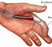 Trigger finger: příčiny, léčba, příznaky, příznaky, prevence