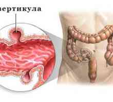 Příznaky a léčba divertikulózy na sigmatu