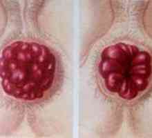 Příznaky a léčba hemoroidů zahájen