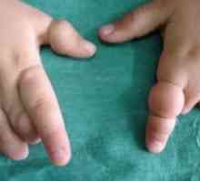 Syndrom amniotické zúžení: příčiny, léčba
