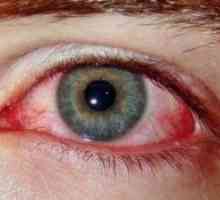 Syndrom červených očí: Léčba