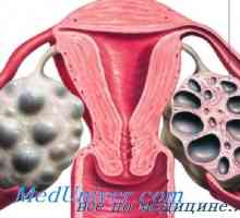 Syndrom polycystických ovarií. Stein-Leventhalův syndrom
