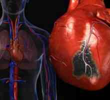 Syndrom náhlé srdeční smrti
