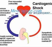 Kardiogenní šok. Fyziologie léčby kardiogenního šoku
