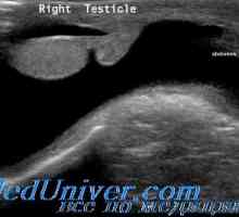 Spermatokély a hydrokéla u dětí. testikulární nádory
