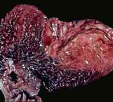 Články o rakovinu žaludku