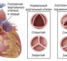 Aortální stenóza
