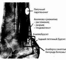 Noha, kotník a dolní třetiny bérce záření a přístrojů diagnostiky. Patologie Achillovy šlachy