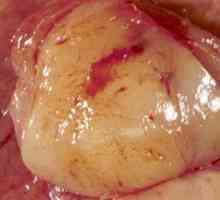 Žaludeční gastrointestinální stromální tumor (GIST, hist)
