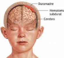 Subdurální hematom mozku: Důsledky ošetření